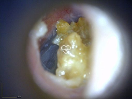 earscope 2.3 result